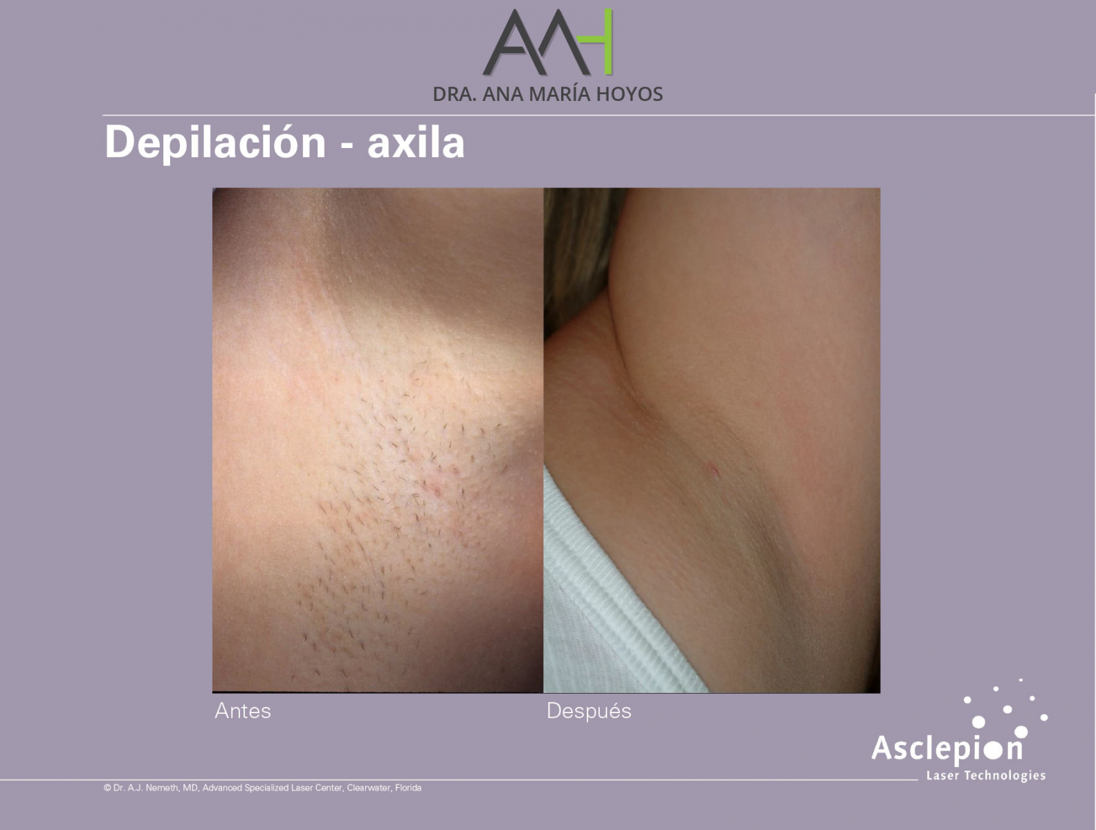 Depilacion-AXILA-01-01
