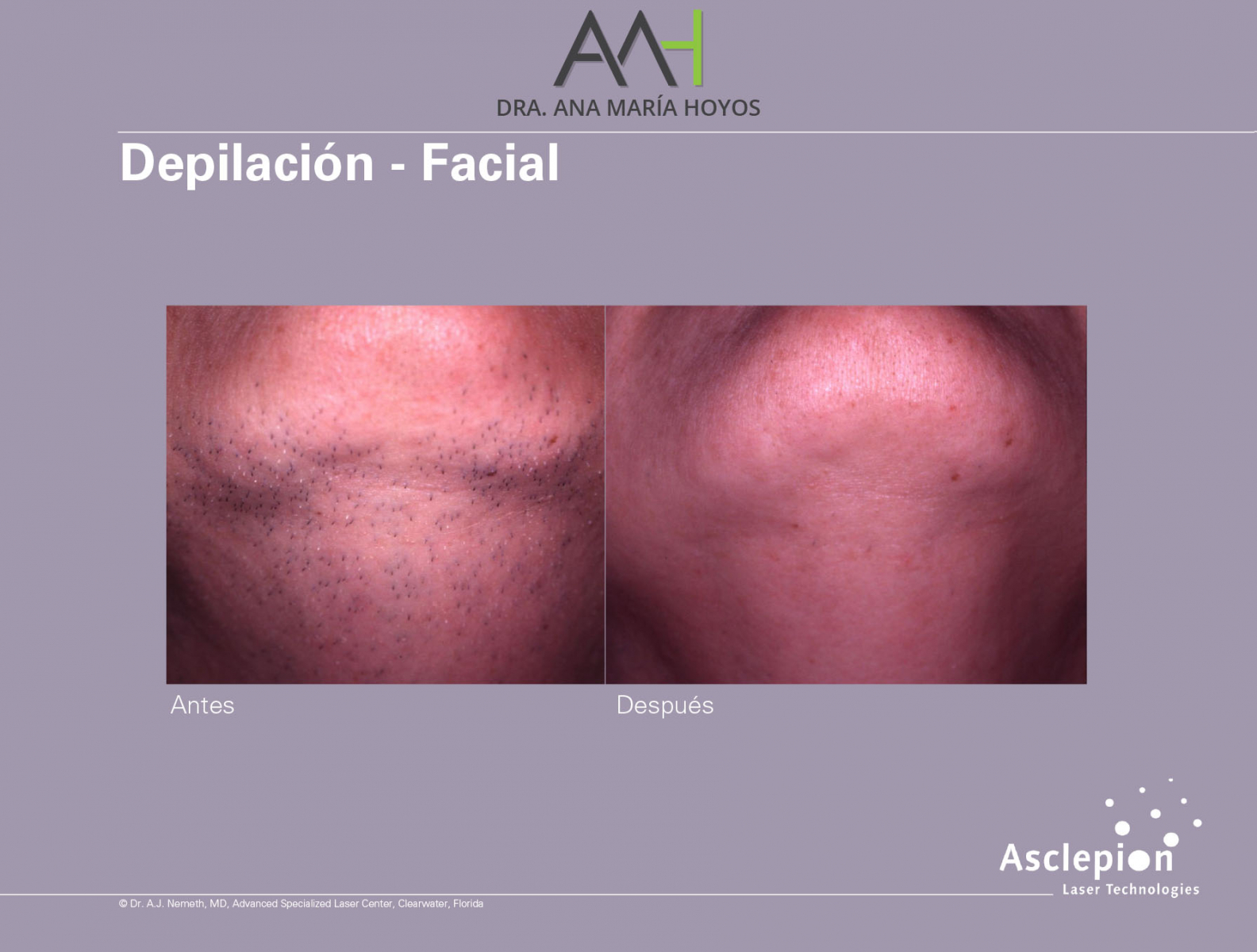 Depilacion-facial-03-01-01