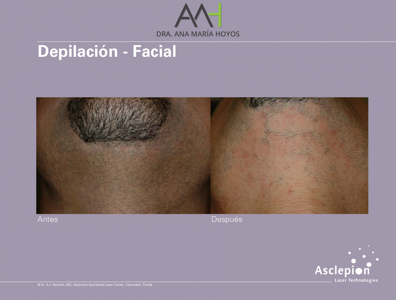 Depilacion-facial-04-01-01-01