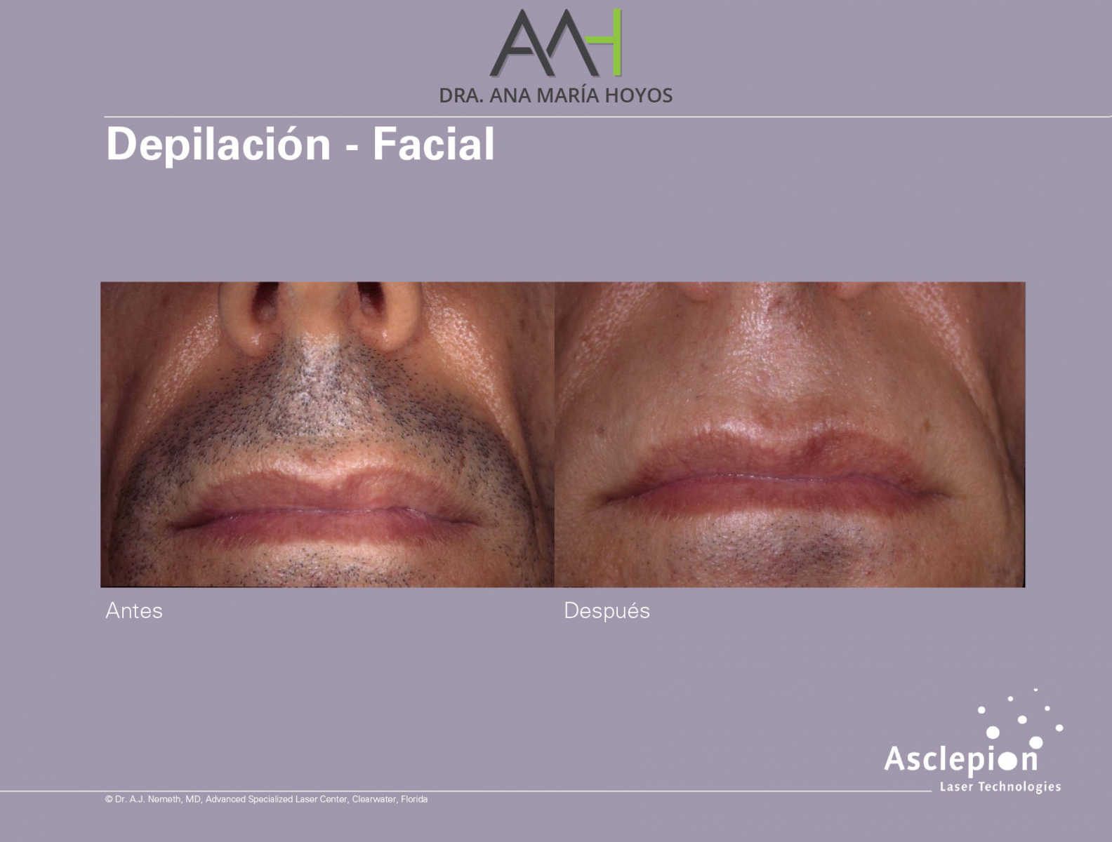 Depilacion-facial-06-01-01